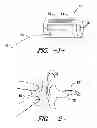Fig. 02 - EAR INSERT FOR RELIEF OF TMJ DISCOMFORT AND HEADACHES
