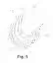 Fig. 10 - Corrugated solder pre-form and method of use