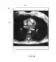 Fig. 09 - Method and system for correction of lung density variation in positron emission tomography using magnetic resonance imaging