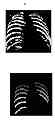 Fig. 01 - Rib suppression in radiographic images