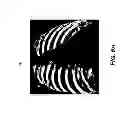 Fig. 07 - Rib suppression in radiographic images