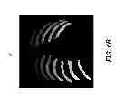 Fig. 08 - Rib suppression in radiographic images