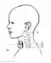 Fig. 01 - Methods and devices for treating primary headache