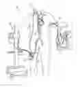 Fig. 01 - Percutaneous right ventricular assist apparatus and method