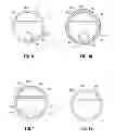 Fig. 05 - Dialysis catheter assembly
