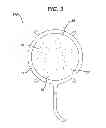 Fig. 04 - Chondrocyte Container and Method of Use