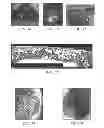 Fig. 08 - System for percutaneously administering reduced pressure treatment using balloon dissection