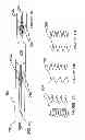 Fig. 06 - Methods and apparatus for renal neuromodulation