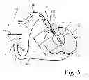 Fig. 06 - Cool RF electrode