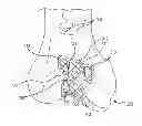 Fig. 01 - Unicompartmental customized arthroplasty cutting jigs