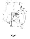 Fig. 22 - Unicompartmental customized arthroplasty cutting jigs