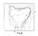 Fig. 33 - Unicompartmental customized arthroplasty cutting jigs
