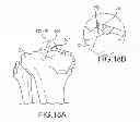 Fig. 35 - Unicompartmental customized arthroplasty cutting jigs