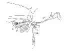 Fig. 01 - Closed system pneumatic impact lithotripsy
