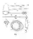 Fig. 02 - Closed system pneumatic impact lithotripsy