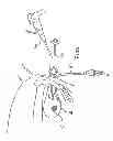 Fig. 07 - Closed system pneumatic impact lithotripsy