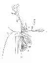 Fig. 09 - Closed system pneumatic impact lithotripsy