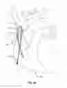 Fig. 04 - LEAD REMOVAL SLEEVE
