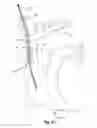 Fig. 05 - LEAD REMOVAL SLEEVE