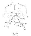 Fig. 303 - Robotic catheter system and methods