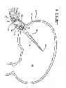 Fig. 02 - ENDOLUMENAL RESTRICTION METHOD AND APPARATUS