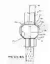 Fig. 07 - ENDOLUMENAL RESTRICTION METHOD AND APPARATUS