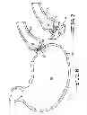Fig. 09 - ENDOLUMENAL RESTRICTION METHOD AND APPARATUS