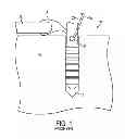 Fig. 02 - Anti-backup suture anchor