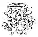 Fig. 01 - Crossbar spinal prosthesis having a modular design and related Implantation methods