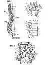Fig. 02 - Crossbar spinal prosthesis having a modular design and related Implantation methods