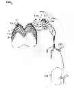 Fig. 01 - Method for treating hypertension via electrical stimulation of neural structures