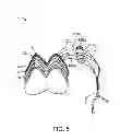 Fig. 05 - Method for treating hypertension via electrical stimulation of neural structures
