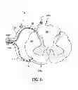 Fig. 09 - Method for treating hypertension via electrical stimulation of neural structures