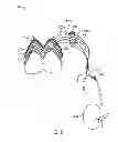 Fig. 10 - Method for treating hypertension via electrical stimulation of neural structures