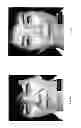 Fig. 07 - ENHANCED LIGHT BASED LIPOPLASTY