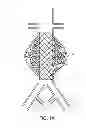 Fig. 02 - Devices and methods for treatment of vascular aneurysms