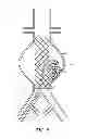 Fig. 07 - Devices and methods for treatment of vascular aneurysms