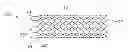 Fig. 01 - Stents with attached looped ends