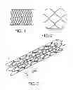 Fig. 02 - Stents with attached looped ends