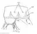 Fig. 01 - Heart valve sewing cuff