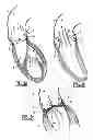 Fig. 02 - Collapsible prosthetic valve having an internal cover