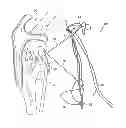 Fig. 01 - Adjustable suture-button construct for knotless stabilization of cranial cruciate deficient ligament stifle