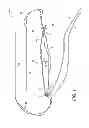 Fig. 02 - Adjustable suture-button construct for knotless stabilization of cranial cruciate deficient ligament stifle