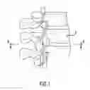 Fig. 02 - Method for treatment or evacuation of intervertebral disc