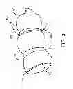 Fig. 04 - ARTICULATING RESTRAINT DEVICE