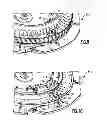 Fig. 08 - Method and fixture for airfoil array assembly