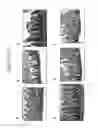 Fig. 03 - Oral therapy of necrotizing enterocolitis