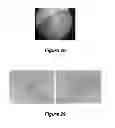 Fig. 25 - Compositions and methods for localized drug delivery through mammary papillae