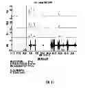 Fig. 11 - Techniques for evaluating urinary stress incontinence and use of involuntary reflex cough as a medical diagnostic tool