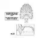 Fig. 64 - Techniques for evaluating urinary stress incontinence and use of involuntary reflex cough as a medical diagnostic tool